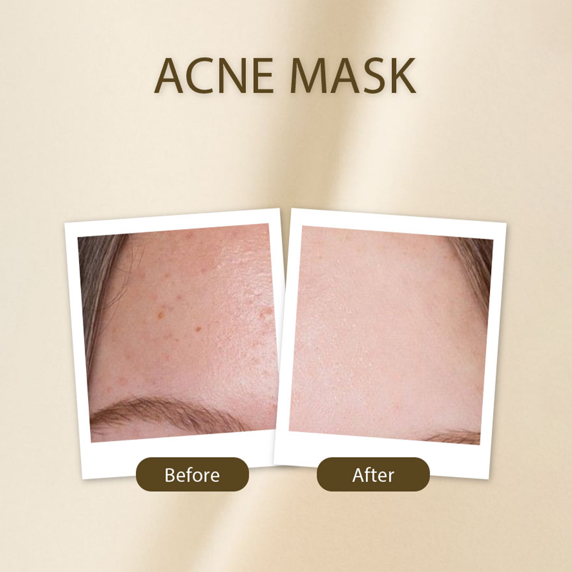 Acne Mask - Golden Girl Cosmetics