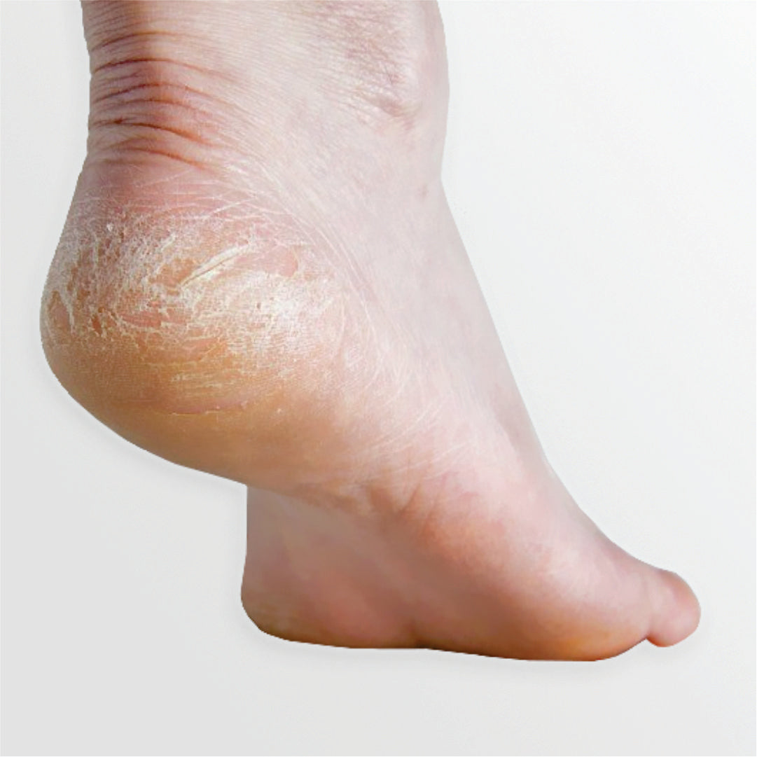 Cutting Callus Shaver